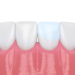 Chipped tooth