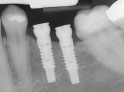 Implant x-ray