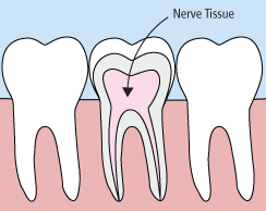Root canal