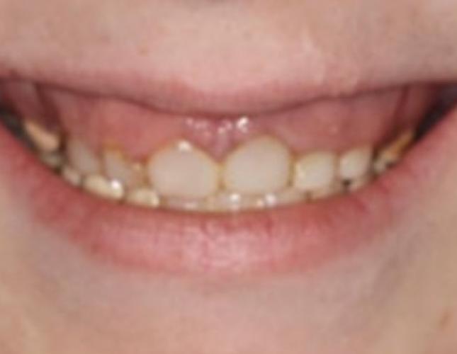 Case 11 before Case 11 before