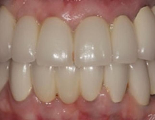 Case 13 after Case 13 after