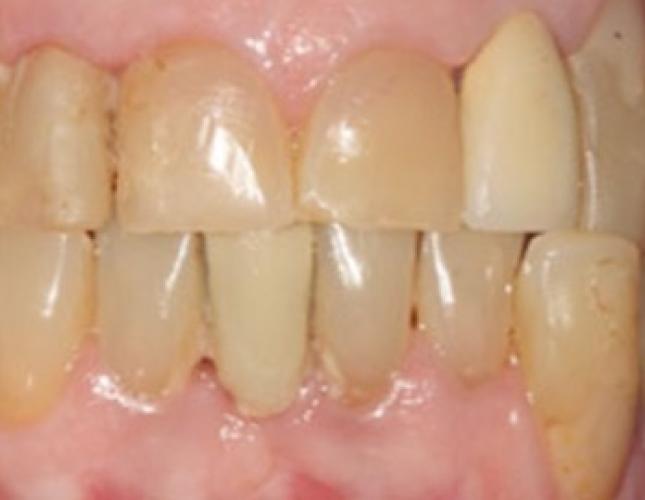 Case 13 before Case 13 before