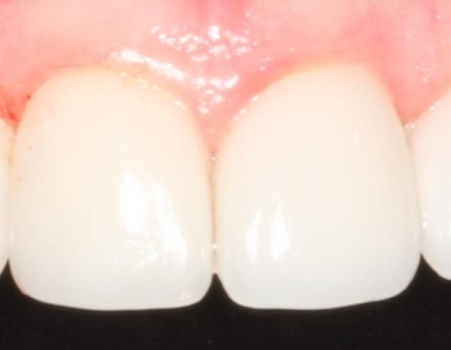 Case 14 after