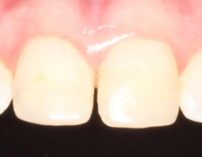 Case 14 before