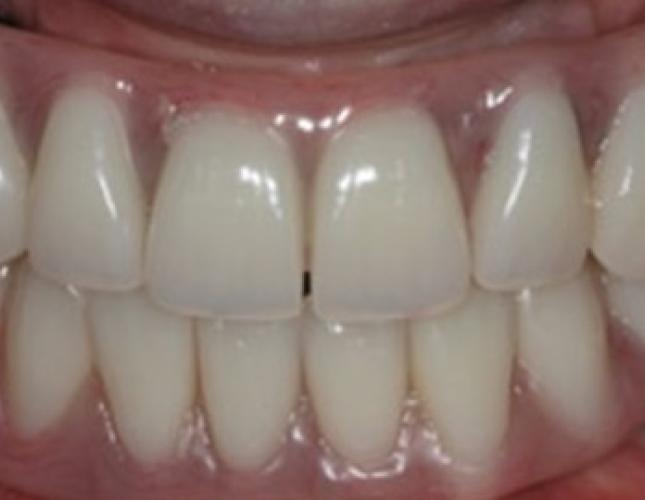 Case 17 after