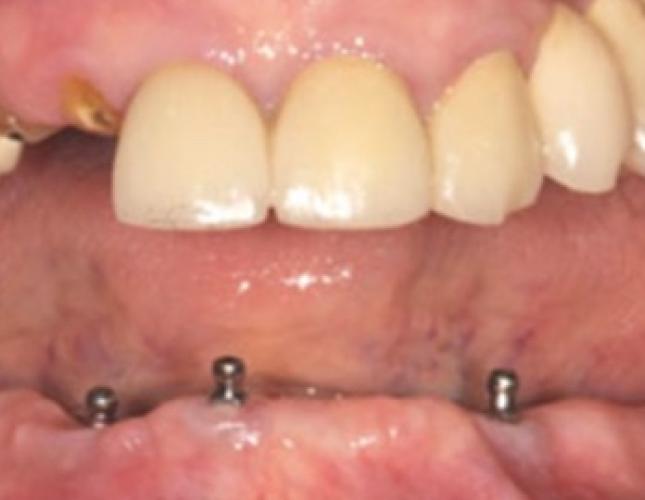 Case 17 before