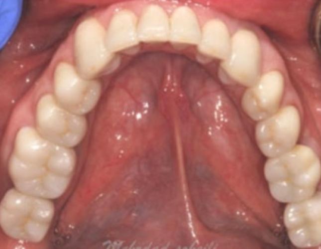 Case 18 after Case 18 after