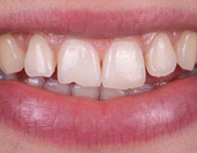 Case 1 Before Case 1 Before