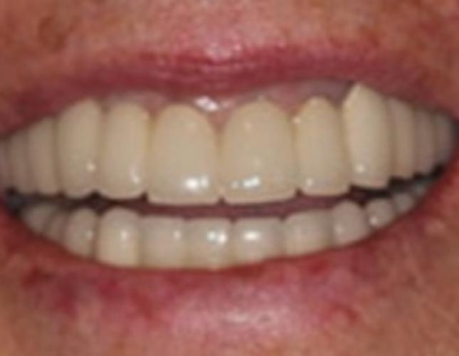 Case 21 after