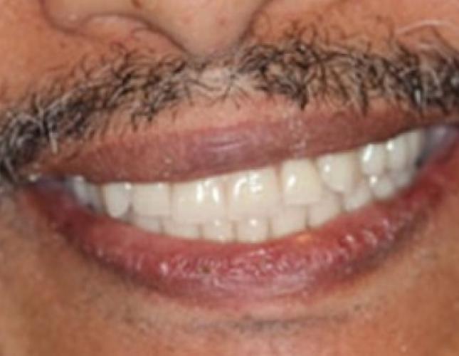 Case 22 after