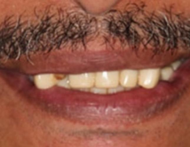 Case 22 before