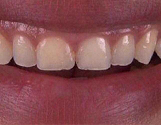 Case 2 Before Case 2 Before