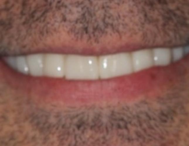 Case 4 after