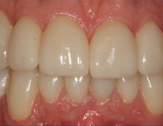 Case 5 after