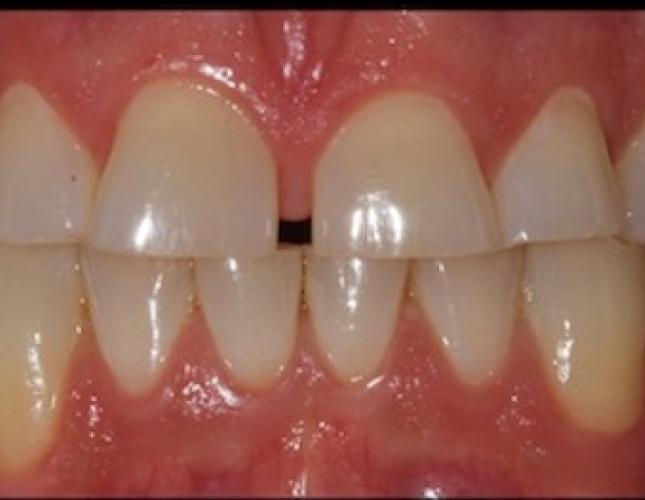 Case 5 before
