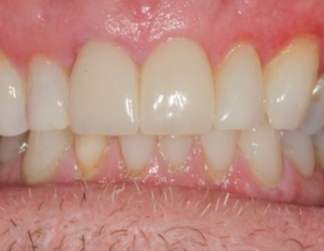 Case 6 after Case 6 after