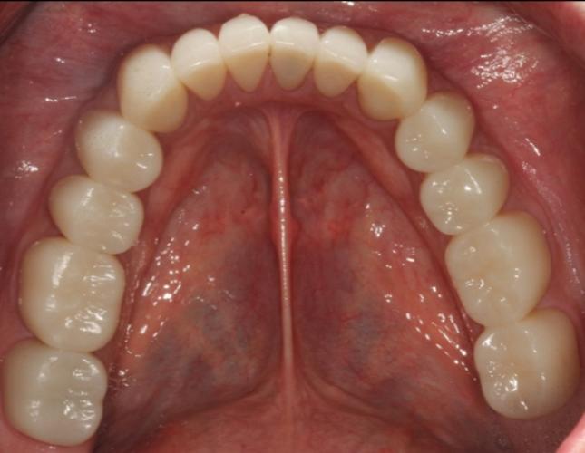case 14 after case 14 after