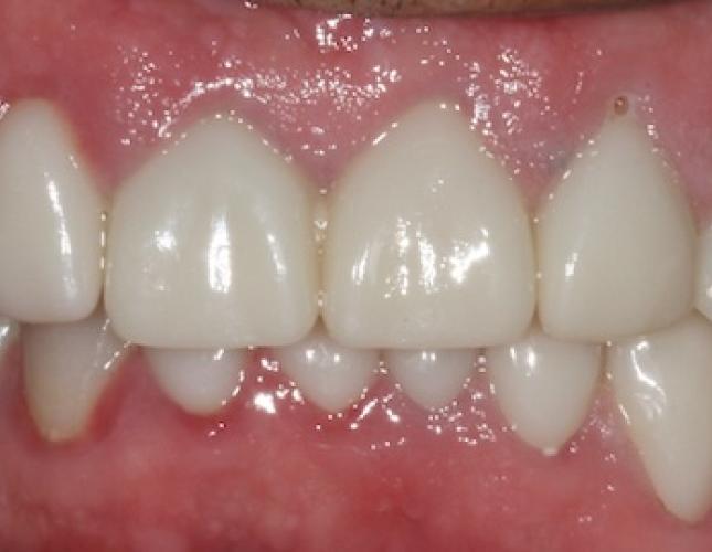 Case 21 after Case 21 after