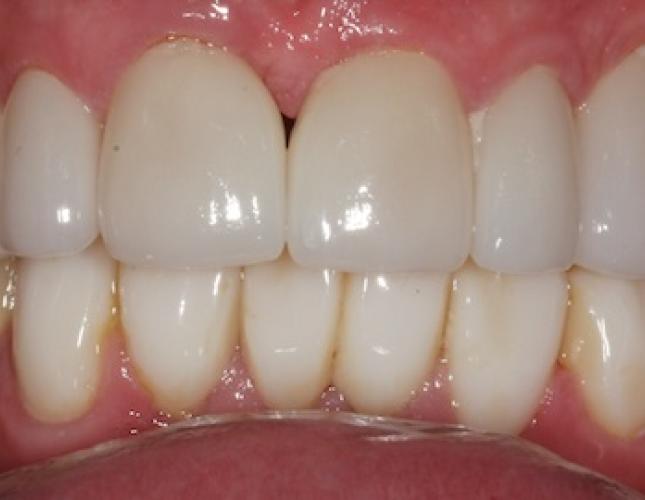 Case 22 after Case 22 after