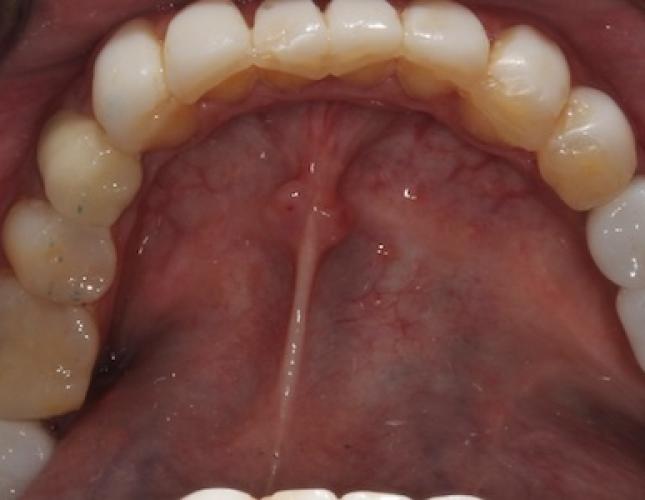 Case 22 after