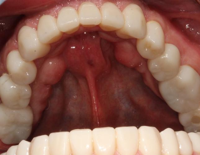 Case 23 after