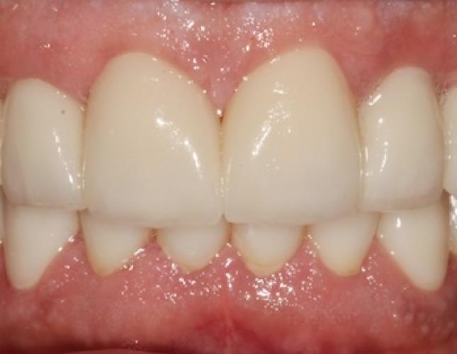 Case 23 after Case 23 after