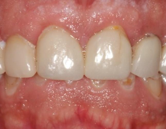 Case 23 before Case 23 before