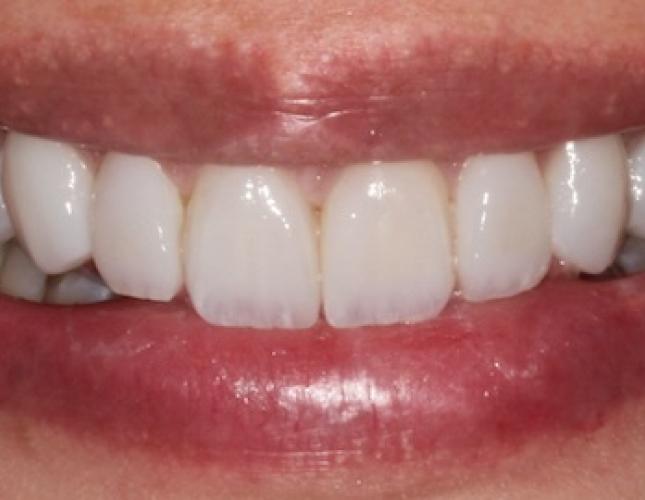 Case 4 after Case 4 after