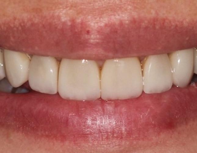 Case 4 before Case 4 before